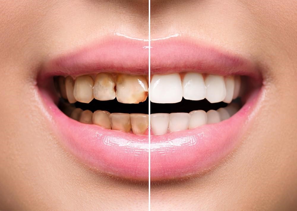 Full mouth rehabilitation treatment Chennai