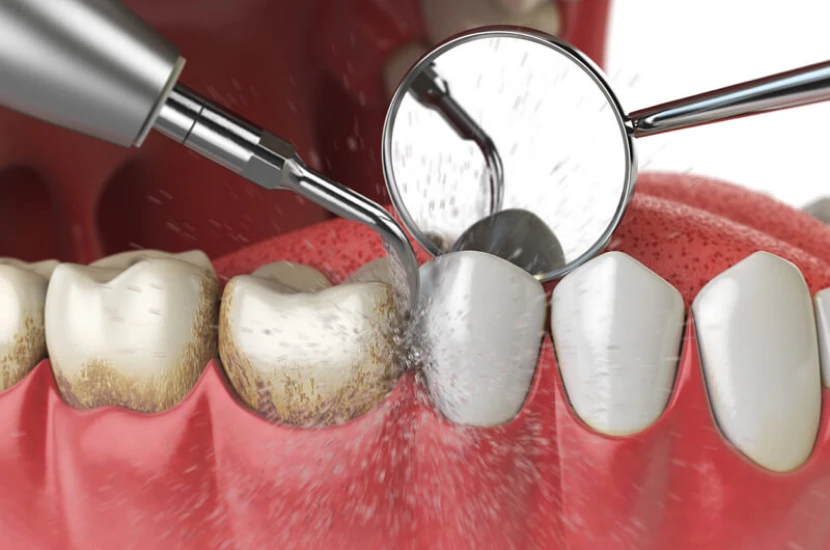 Gum treatment procedure in Chennai