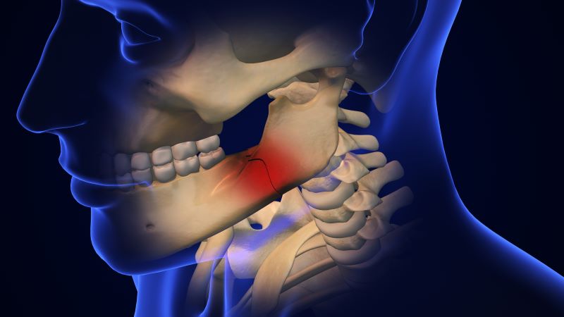 Dental implant procedure in Chennai